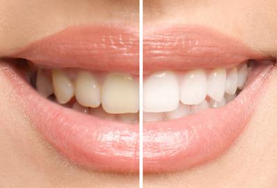 teeth whitening Fairfield CT