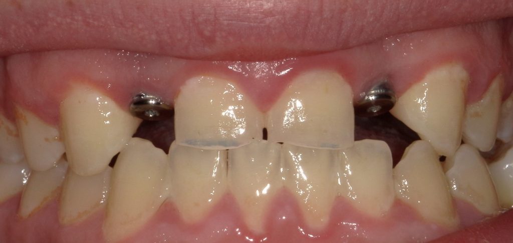 dental implant in fairfield ct