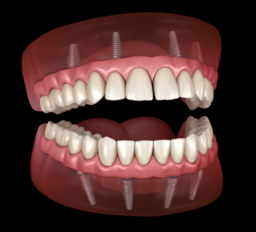 dentist in Fairfield CT, implant-supported dentures, dental implants, dentures stability, jawbone health, no adhesives dentures, Fairfield CT, Jack Vayner DDS, long-term dentures